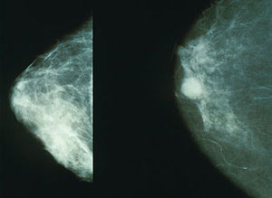 Göğüs kanseri