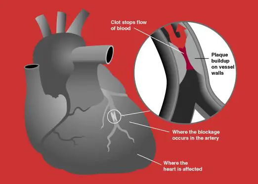 heart attack diagram. heart attack diagram.