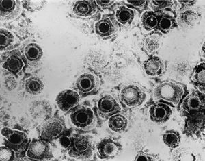 Herpes simpleks virüsü