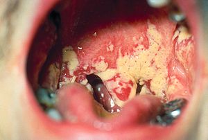 Oral kandidoz