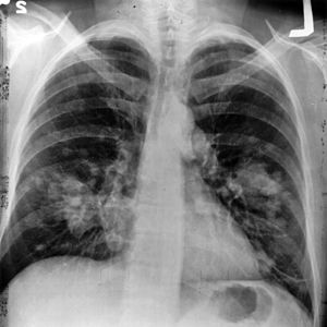 Akciğer kanserleri